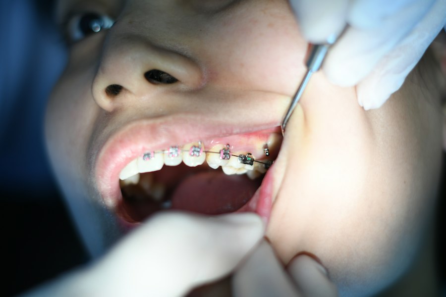 Braces versus clear aligners
