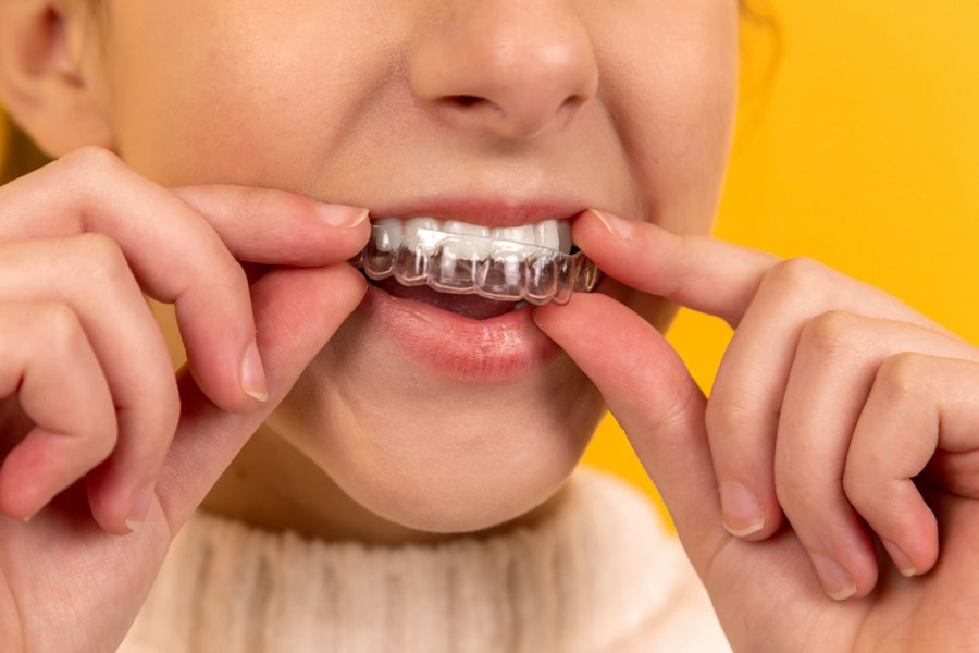 Clear aligner treatment in Dhaka