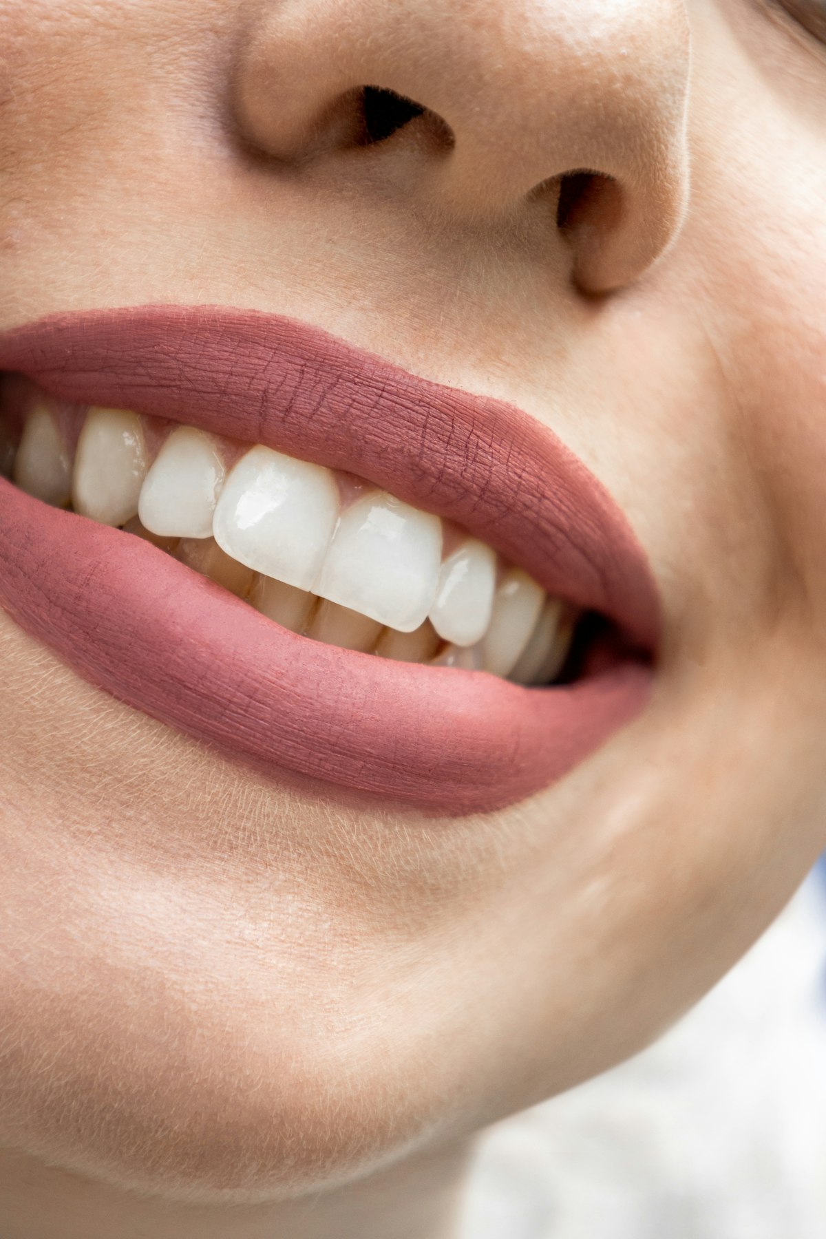 Smile after whitening and veneers at Pearline Dental