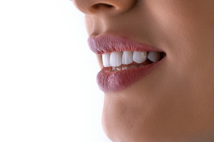 Bright smile after teeth whitening in Dhaka