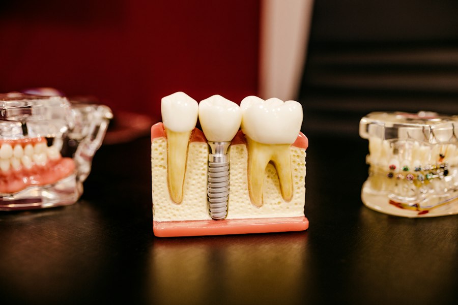 Zirconia crown and veneer model